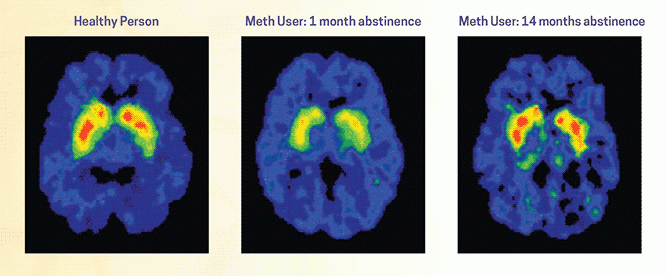 What Percentage of Drug Addicts Recover