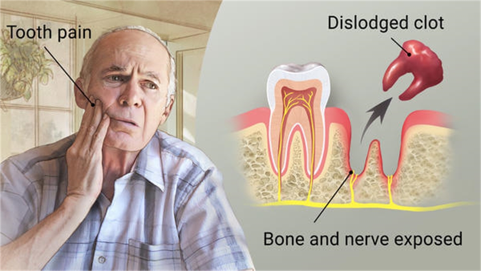 Can Alcohol Cause Dry Socket