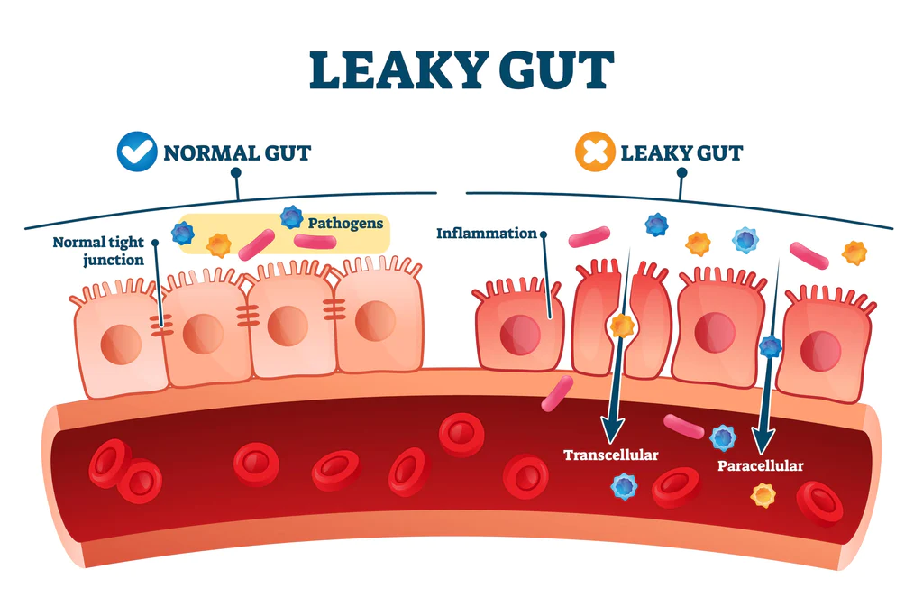 Can Alcohol Cause Leaky Gut