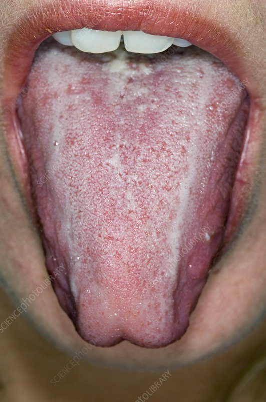 Oral thrush in an alcoholic patient