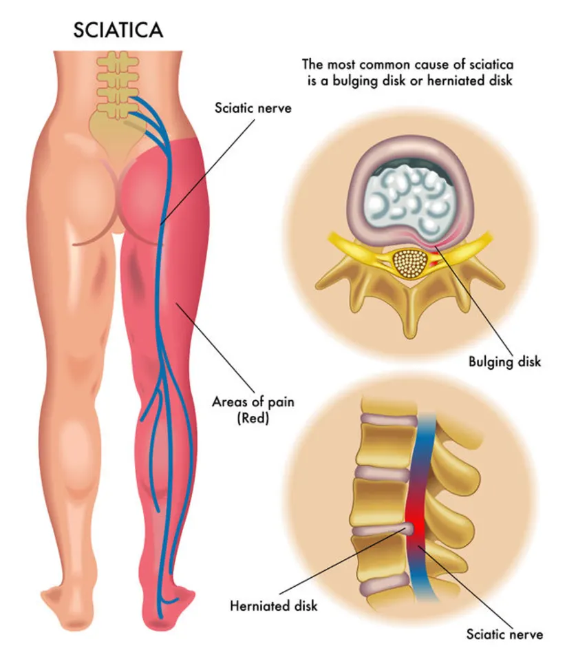 Can Alcohol Cause Sciatica?