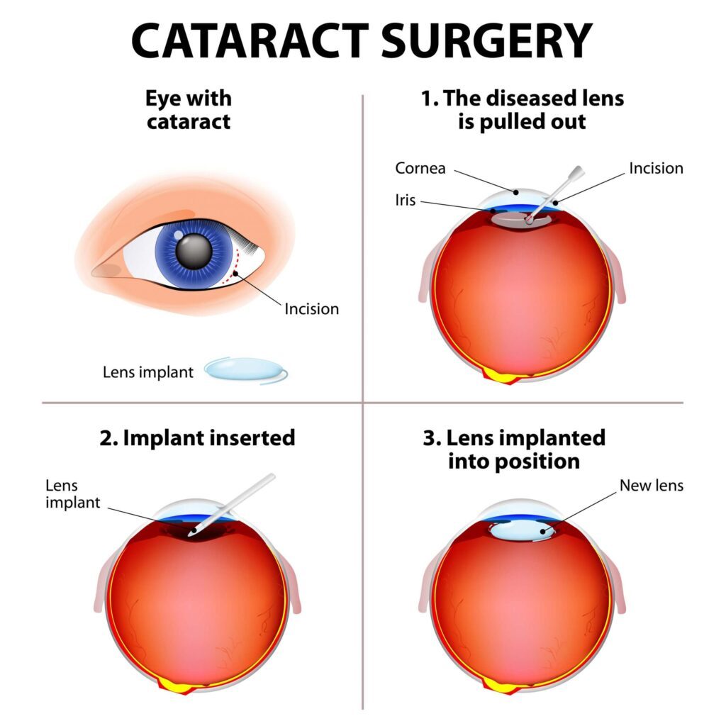 why-no-alcohol-after-cataract-surgery-recovery-ranger