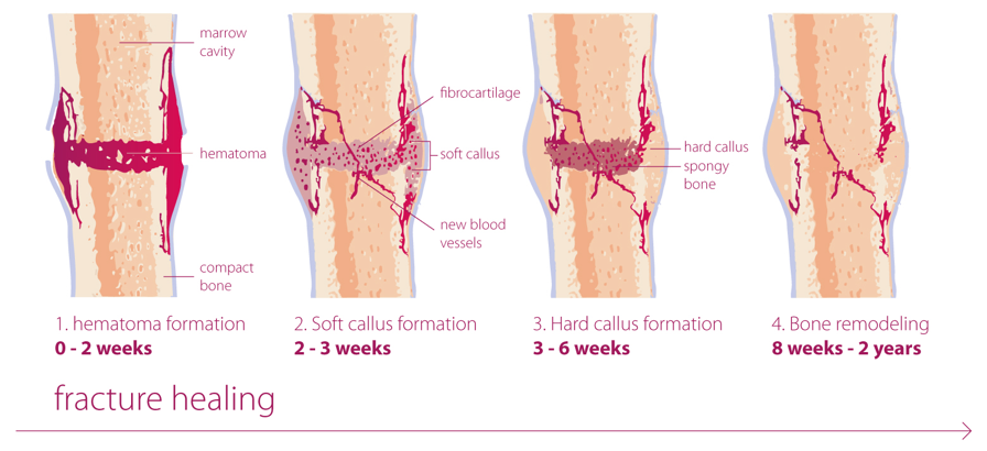 Does Alcohol Affect Bone Healing