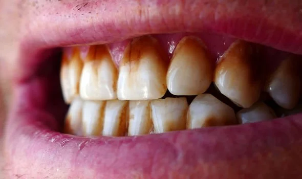 Does Alcohol Stain Teeth