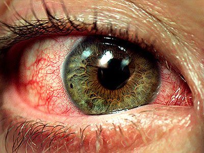 Can Alcohol Cause Bloodshot Eyes? - Recovery Ranger