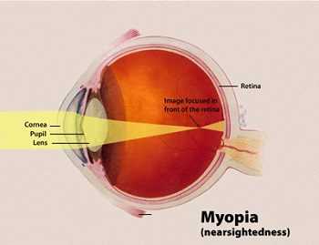 What Is Alcohol Myopia