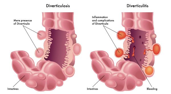 can-alcohol-trigger-diverticulitis-recovery-ranger